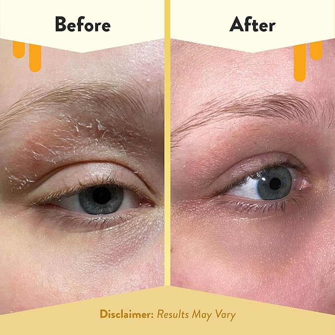 ECZEMA HONEY Multi Peptide Eye Cream & Nourishing Face Serum - Bundle for Sensitive & Dry Skin - Cruelty Free